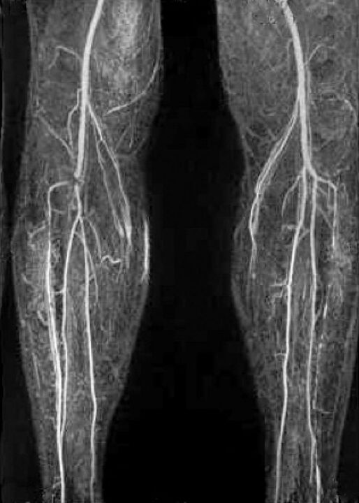 Naczyń x -ray