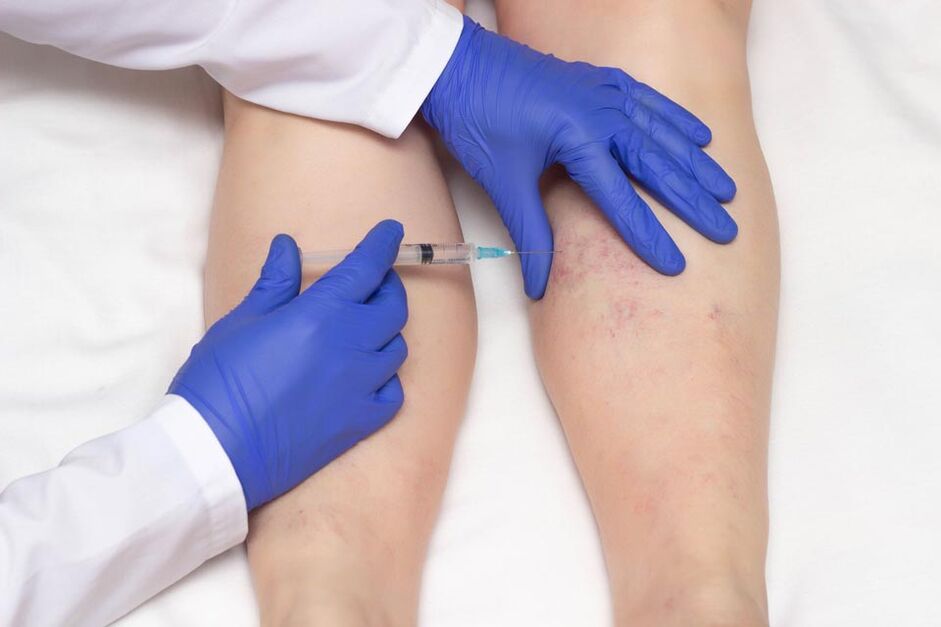 Skleroterapia to metoda leczenia żylaków