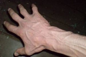 metody leczenia żylaków rąk