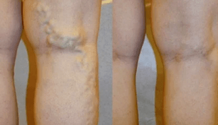 oznaki i objawy żylaków nóg u mężczyzn