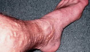 przyczyny żylaków nóg u mężczyzn