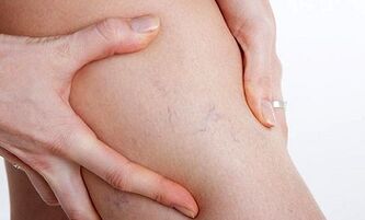 przyczyny rozwoju żylaków nóg