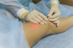 leczenie żylaków laserem istota zabiegu
