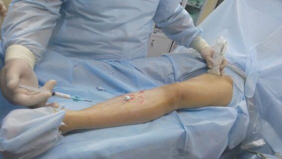 operacja żylaków na nogach
