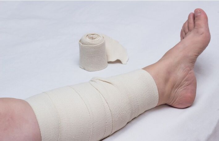 bandaż kompresyjny na nogę na żylaki