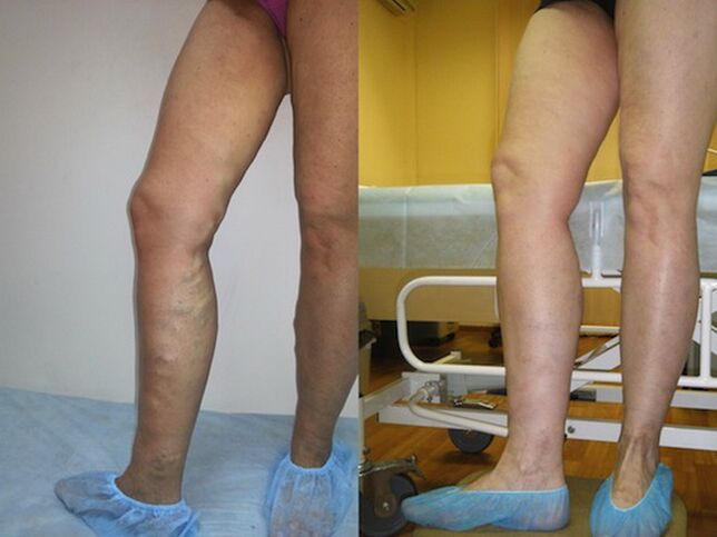 Nogi przed i po laserowym leczeniu żylaków