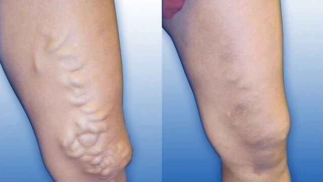 Nogi przed i po leczeniu ciężkich żylaków