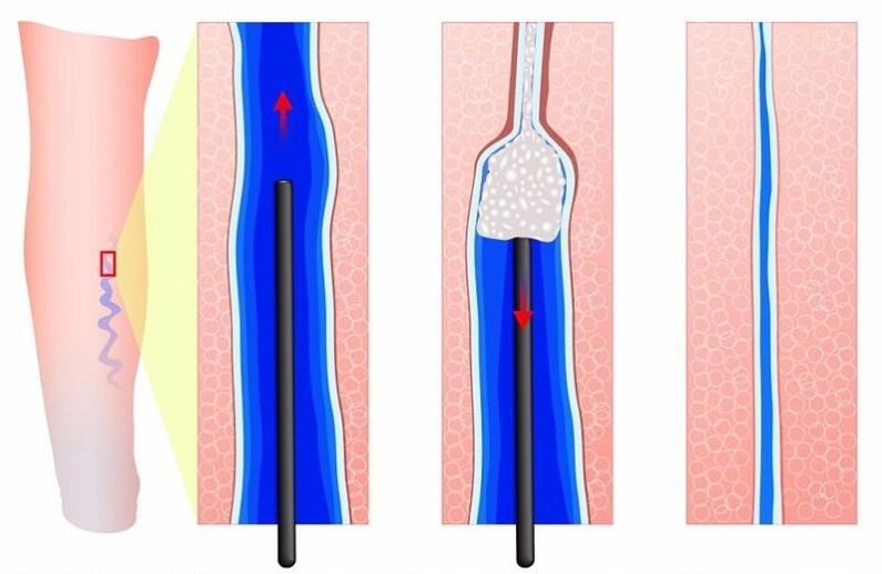 skleroterapia żylaków nóg u mężczyzn